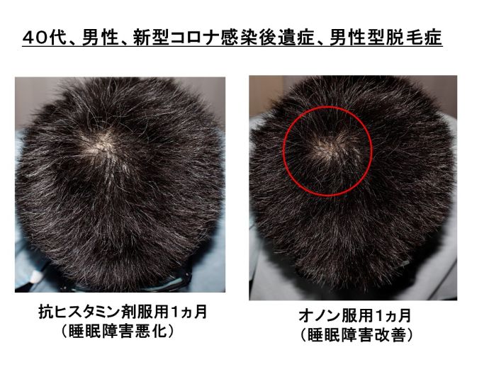 円形脱毛症　病院